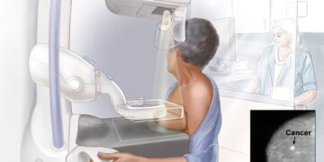 U.S panel lowers breast cancer screening age, lays emphasis on black women