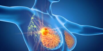 BREAST CANCER TREATMENT BREAKTHROUGH: Drug found to reduce risk of cancer coming back