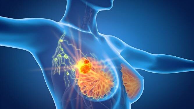 BREAST CANCER TREATMENT BREAKTHROUGH: Drug found to reduce risk of cancer coming back