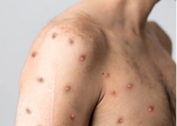 NCDC confirms 39 cases of monkeypox in Lagos State, Ogun, others