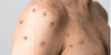 NCDC confirms 39 cases of monkeypox in Lagos State, Ogun, others