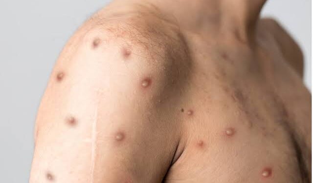 NCDC confirms 39 cases of monkeypox in Lagos State, Ogun, others