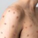 NCDC confirms 39 cases of monkeypox in Lagos State, Ogun, others