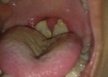 Edo confirms five diphtheria cases, two deaths