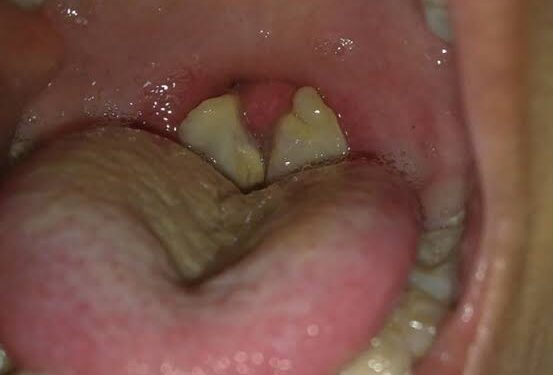 Edo confirms five diphtheria cases, two deaths