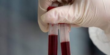 New trial raises hope of detecting over 50 cancers through blood test