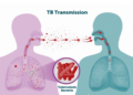 New tuberculosis vaccines to be available from 2029- Gavi